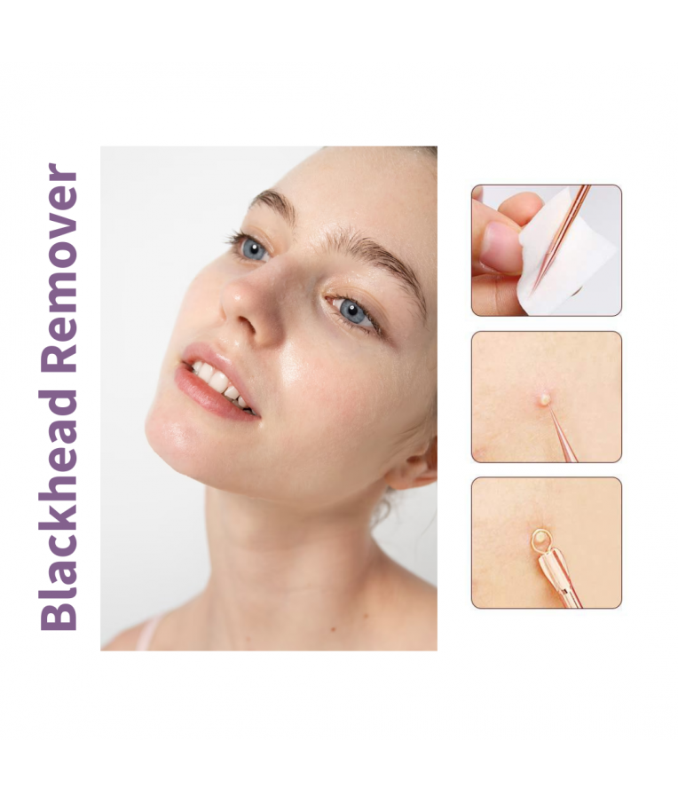 Інструменти косметичні для видалення вугрів MODAY Blackhead Remover 8 пристроїв 
