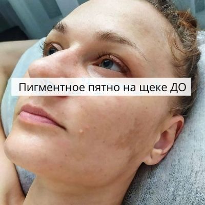 До и ПІСЛЕ. 32 роки . Пігментація та купероз, чутливість в верхній області щік