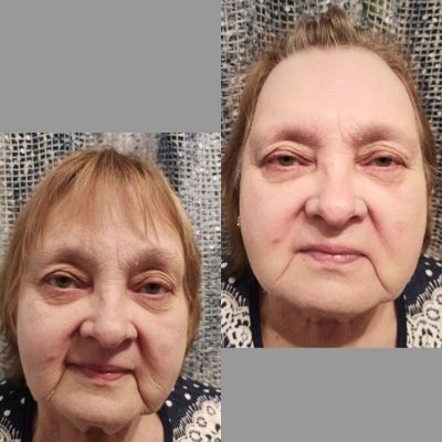 ДО и ПОСЛЕ. Модель 75 лет. Лицо